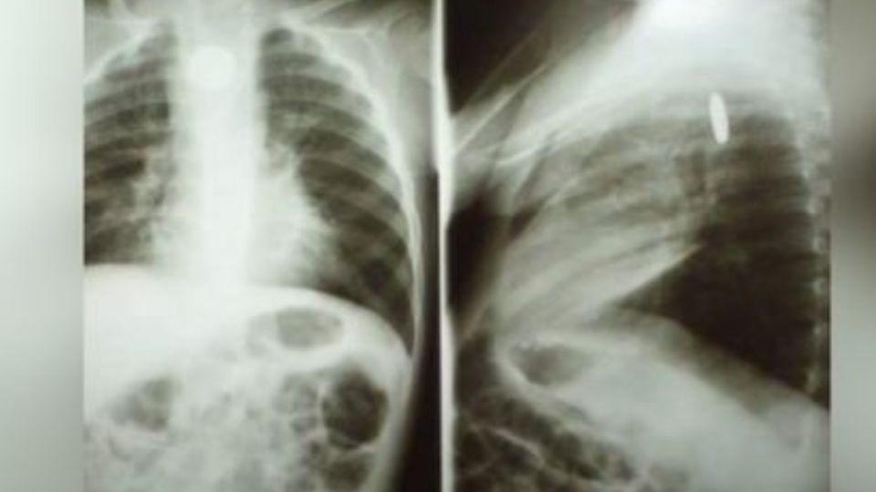 PULMONES